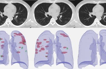 Влияние covid-19 на органы дыхания человека 64